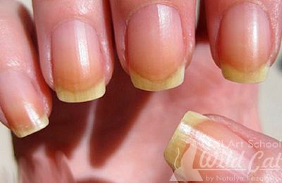 Почему желтеют ногти на ногах: 7 неочевидных причин